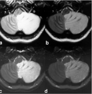 Fig 8. A 56-year-old man with diffuse radiation changes of the cerebral white matter and corpus callosum.Asuppression of the diseased white matter and corpus callosum compared with normal brain tissue