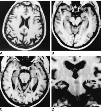 Fig 2. Axial (Atance;three-dimensional gradient-echo MR im-ages (10/4/2, 10with Alzheimer disease