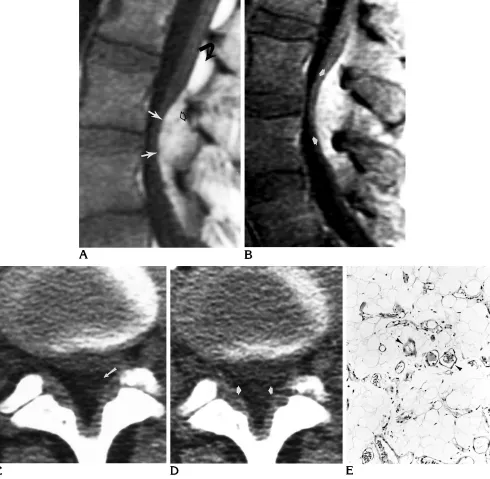 Fig 1. Patient 1: 38-year-old woman with lower back pain of 3 years’ duration., On histologic section, the neoplasm was grossly yellow and had a lobulated appearance
