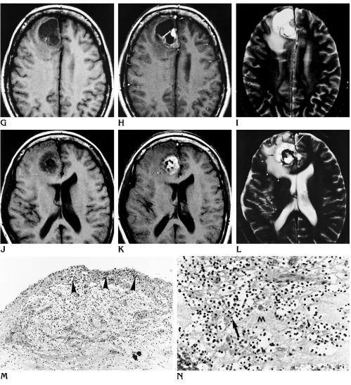 Fig 1, continued.calcification (are located in a neurofibrillary matrix ((intratumoral hemorrhage (arrowG–L, From 1994, precontrast (G, J) and postcontrast (H, K) T1-weighted MR images and T2-weighted (I, L) MR images show a centralwhite arrow) surrounded 