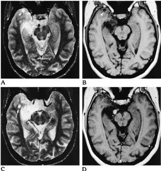 Fig 2. Right temporomesial DNT (patient 13).A–Cspin-echo (, Coronal T2-weighted fast spin-echo (A), heavily T1-weighted inversion-recovery (B), and axial postcontrast T1-weightedC) MR images show multiple large cysts (arrowheads) that appear to replace the