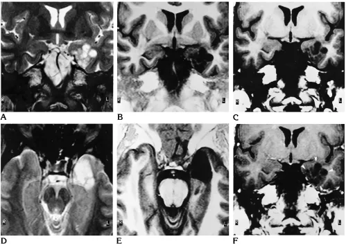 Fig 4. Left temporomesial DNT (patient 16).A–Fpostcontrast (gyrus. There is very little mass effect with slight posterior displacement of the hippocampal head and anterior part of the temporal horn, Precontrast T2-weighted spin-echo (A, D), T1-weighted inversion-recovery (B, E), and T1-weighted precontrast (C) andF) spin-echo MR images show an unenhancing, multicystic lesion (arrowheads) located mainly in the left parahippocampaland no edema.