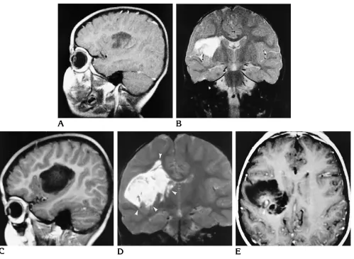Fig 6. Right insular DNT (patient 10).A–Dsubcortical white matter, reaching the striatum but respecting its border