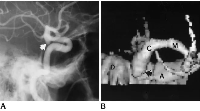 Fig 3. Agiogram shows a small posterior commu-nicating artery aneurysm (inferiorly from the internal carotid artery., Lateral projection carotid an-arrow) directed, Surface-rendered 3-D CTA (viewed