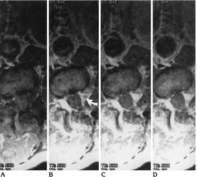 Fig 1. MR images obtained before (Athe scar. In the first image after injection of the contrast medium (in a dog with a surgically modeled recurrent herniated disk
