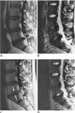 Fig 4. A and B,T1-weighted (before surgery show an extrusion of the L5-S1intervertebral disk