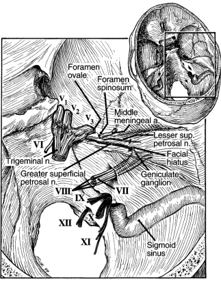 Fig 1. Diagram of the proximal facialnerve including the takeoff of the GSPN.