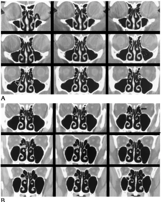 Fig 1. Ascans through the paranasal sinuses usinga section thickness of 1.5 mm, an intersec-tion gap of zero, a gantry angle of zero(perpendicular to the palate), and 200 mA(standard of reference)