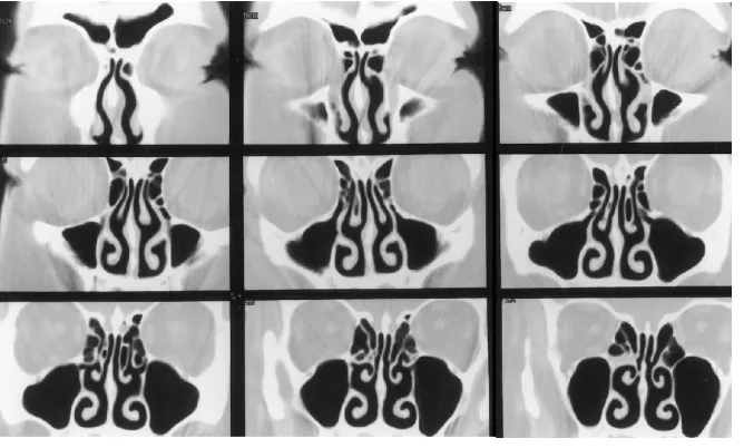 Fig 3. Direct coronal CT scans through