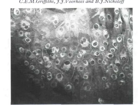 FIGURE 2. IFN-)'-induced expression of HLA-DQ on acetone-fixed keratinocytes showingperinudear and minimal ceil surface staining (origitial x 150).