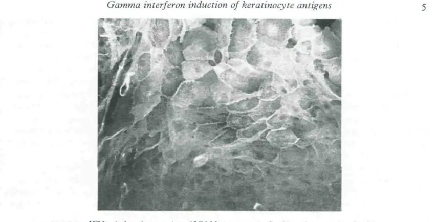 FIGURE 3. IFN-j'-induced expression {i! it,AM-i an accKmc-tixcd kcrannocyiL-s showing intensecell surface and difFuse cytoplasmic staining (original x 150).