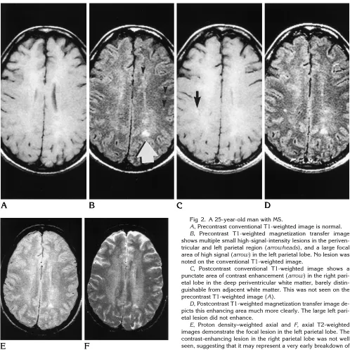 Fig 2. A 25-year-old man with MS.Ashows multiple small high-signal-intensity lesions in the periven-tricular and left parietal region (area of high signal (noted on the conventional T1-weighted image., Precontrast conventional T1-weighted image is normal.B