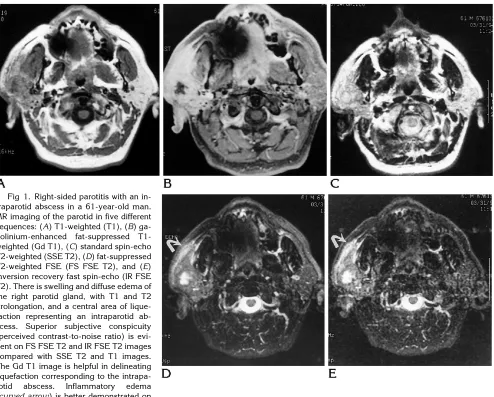 Fig 1. Right-sided parotitis with an in-