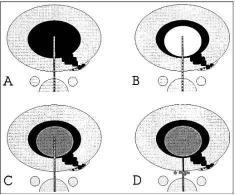 Fig 1. Schematic representation of the procedure.Afollowed by contrast injection, demonstrating, in this case, a leftposterolateral annular tear., Disk puncture using a central posterior transdural approach, One milliliter of lidocaine (or additional contrast) is injected