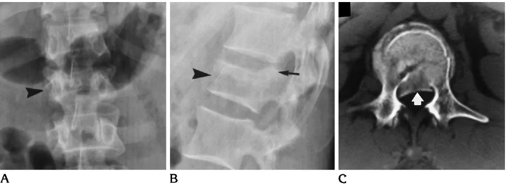 Fig 2. AThere is just less than 50% compression of the vertebral body. This case was called stable by three of six plain-film readers