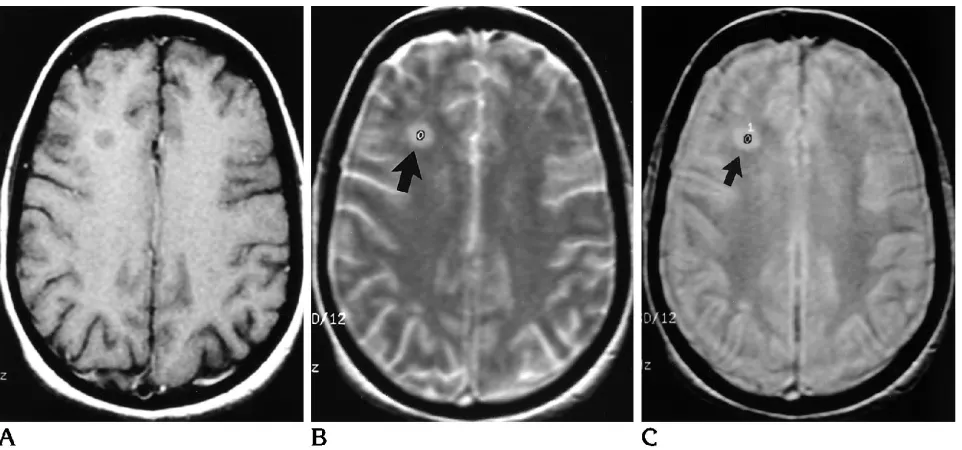 Fig 1. Examples of white matter lesions