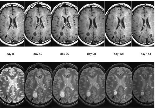 Fig 1. The life of a multiple sclerosis lesion. Serial MR follow-up of a multiple sclerosis lesion (arrowswhite matter of a 37-year-old man