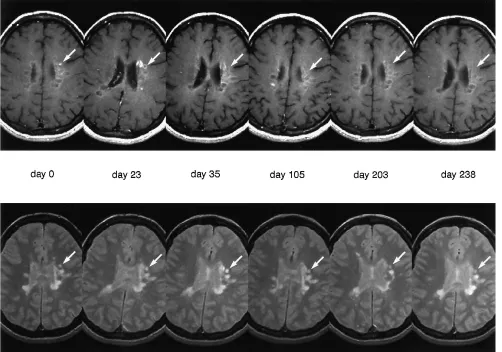 Fig 2. Signal intensity pattern changes of a multiple sclerosis lesion. A lesion (arrowsof a 36-year-old woman is shown at six time points, beginning with the time of first detection (day 0) on contrast-enhanced (proton density–weighted (which evolves into