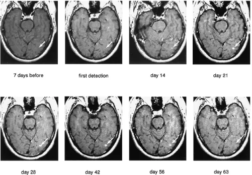 Fig 4. Duration of contrast enhancement in a new multiple sclerosis lesion. The location of a lesion (arrowcontrast-enhanced studies of a 37-year-old man