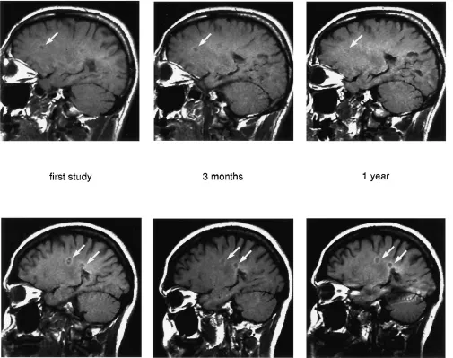 Fig 6. Ring hyperintensity pattern of multiple sclerosis lesions on unenhanced T1-weighted MR images