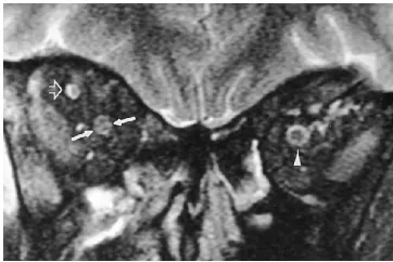 Fig 6. Optic neuritis in a patient with