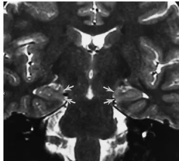 Fig 1. Fast spin-echo T2-weighted (4000/100) coronal MR