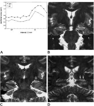 Fig 4. Athe diffuse type of hippocampal sclerosis(patient 18). Discrepancy between theright and left curves is noted diffusely from, Hippocampal area curves ofthe hippocampal head to the tail.