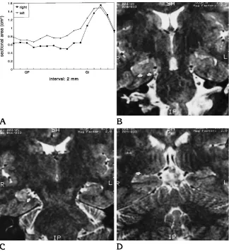Fig 5. Abody (els of the hippocampal head (of the diffuse type of hippocampal scle-rosis (patient 1)