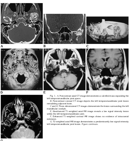 Fig 1. A, Noncontrast axial CT image demonstrates a calcified mass expanding the