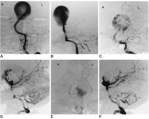 Fig 1. Athe presence of a giant basilar tip aneurysm (a termination-type aneurysm). The basilar artery is angled to the left