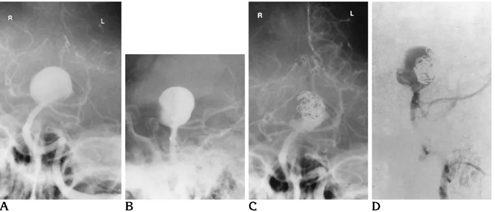 Fig 2. Aprocedure. The coils are again positioned directly in the path of the high-velocity inflow jet