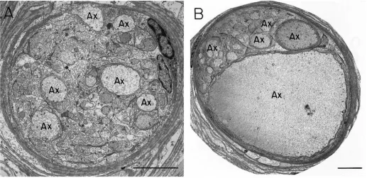 Fig. 4. Electron micrographs of two adjacent axons from the same transverse section, 1500µm distal to the cut end, 90 days after axotomy.(A) The axon tube is ﬁlled with cells and axon proﬁles
