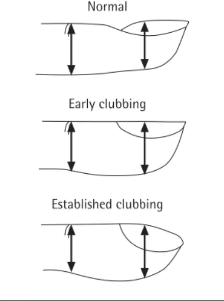 Figure 2. The distinction of normal and  clubbed fingers. Note that the earliest signs  are increased AP diameter compared to the  distal IP joint and flattening of the nail  an-gle
