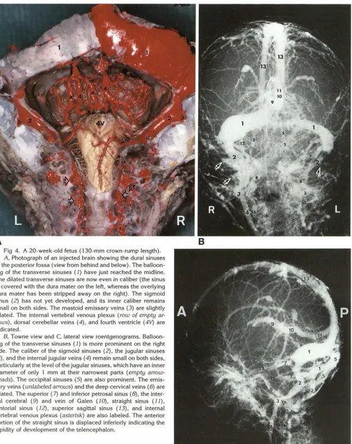 Fig 4. A 20-week-old indicatedsmall dilated. The dilated transverse sinuses are of dura sinus (2) has rows) , is covered ing the A, fetus (130-mm crown-rump length)