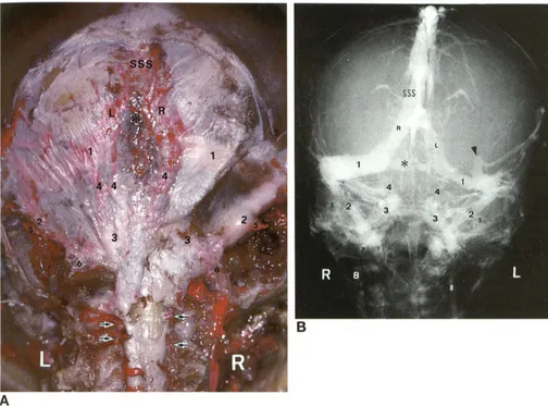 Fig 5. A 24-week-old the right torcular foramen a marked A, fetus (215-mm crown-rump length)