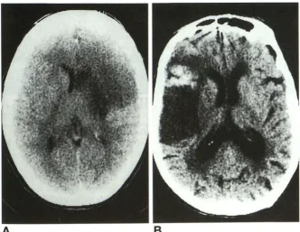 TABLE 1: lnterobserver agreement between the two experienced neuroradiologists 