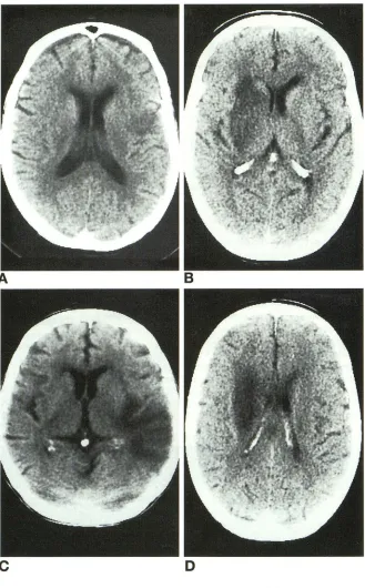 Fig 3. middle Other examples of infarcts in the cerebral artery territory. 