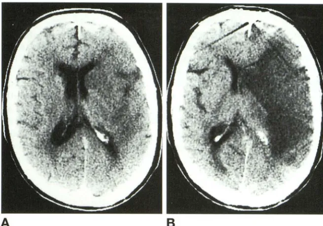 TABLE 2: Interobserver agreement between one of the two experienced neuroradiologists (J.M.W.) and the six general radiologists in training 
