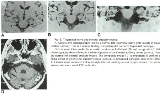 Fig 6. Trigeminal nerve and internal auditory recess. A, 