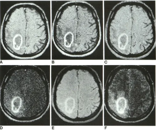 Fig 4. Glioblastoma nonenhancing become normal edema £, A, multiforme. The Gd-enhanced images display ring enhancement, cystic or necrotic centers, and surrounding tumor or edema