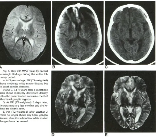 Fig 6. Boy neurologic with MMA (case 5): normal findings during the entire fol-