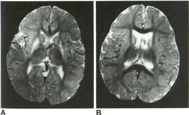 Fig 7. Boin the bilaterally. y with MMA (case 19): muscular hypotonia and severe choreoathetosis