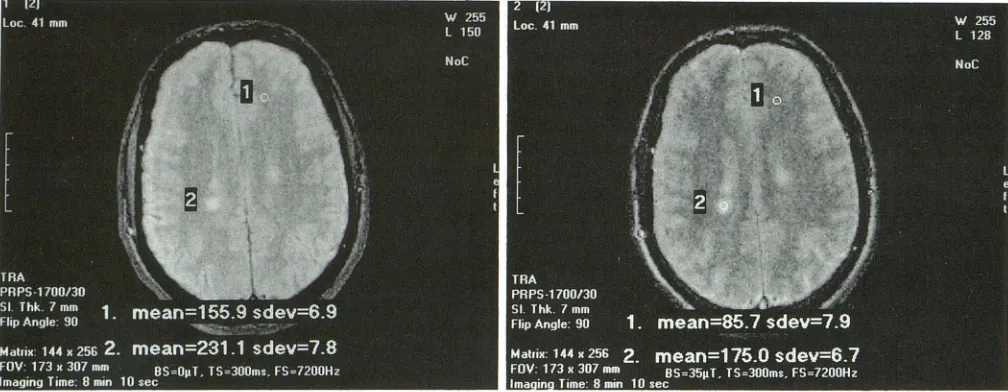 Fig 1. imright m aventricles. Region age king Fig Example of a "mask" image in a patient with multiple sclerosis