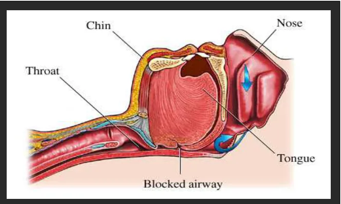 Figure 4: A Constricted Airway of Obstructive Sleep Apnea. Reference: American Sleep Diagnostics Center,  http://www.american-sleep.com/images/sleep_apnea_image_2%5B1%5D.jpg (accessed October 12, 2009)