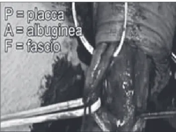 Figure  2.  Endocavernous  clearance  even  of  the smallest plaques.