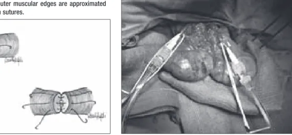Figure 1. Inner mucosal edges are approximated with interrupted  10-0 nylon sutures and outer muscular edges are approximated  with interrupted 9-0 nylon sutures.