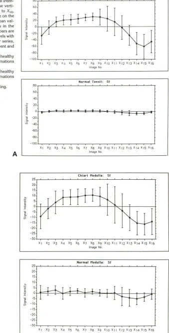 Fig 4. A positive ues reprnegative horizontal axis. Chiari tonsils and cal axis, cardiac analyses sishown