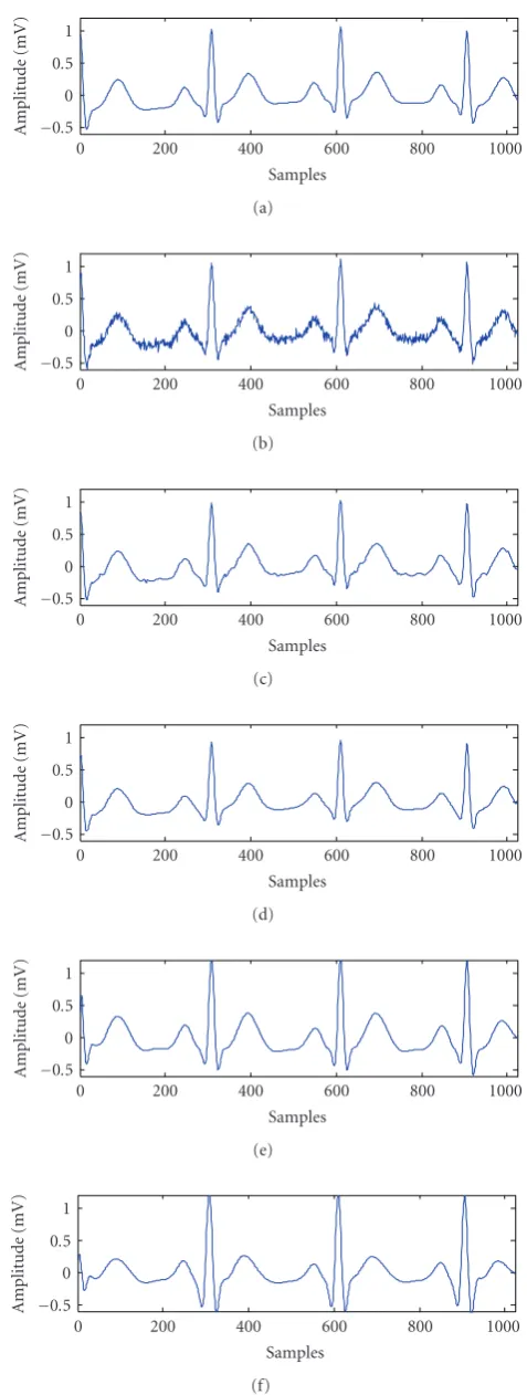 Figure 5: Typical results of dilated signal of 6 dB. (a) Clean ECG, (b) noisy input signal, (c) WTﬀerent methods for an input simu-(hard), (d) WT (soft), (e) MABWT (hard), and (f) MABWT (soft).