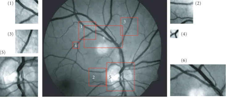 Figure 2: Example of retinal fundus image with the selected templates: (1)–(3) medium template (100(40 × 100 pixels); (4) small template × 40 pixels); (5) large template which includes the optic nerve (180 × 180 pixels); (6) large template (240 × 140 pixels).