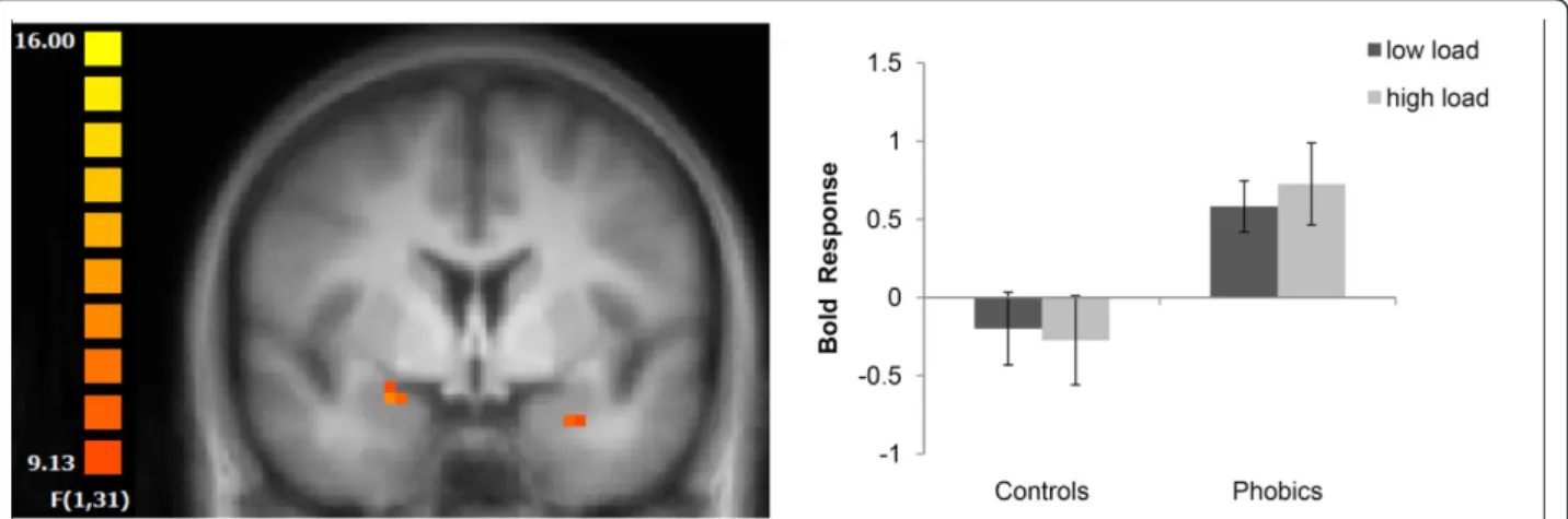 Figure 2 Amygdala responses to spider vs mushroom pictures. Increased activation in the right and left amygdala in phobic subjects was found regardless of perceptual load